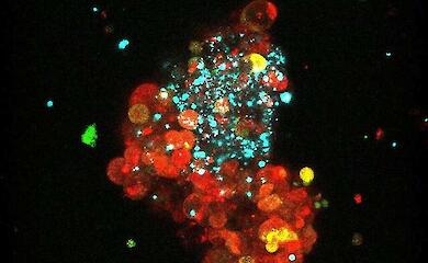 Wissenschaftler haben einen Weg gefunden, luminalen Brustkrebs f&uuml;r das Immunsystem angreifbar zu machen