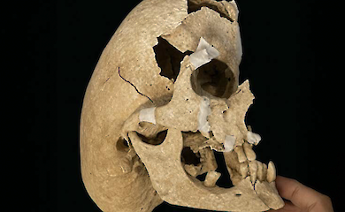 Archäologen haben einen Ritter mit einer schweren Schädeldeformierung gefunden - und herausgefunden, wie er lebte und starb